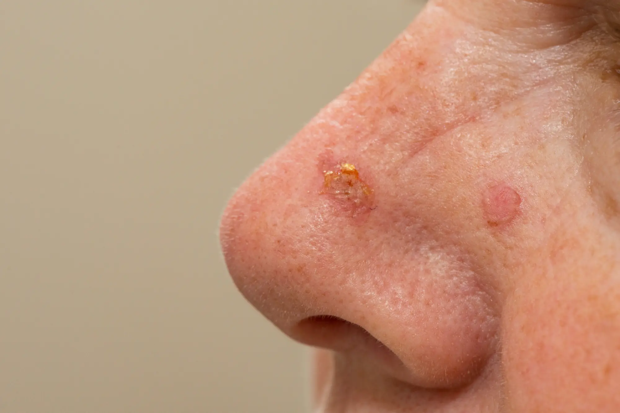 At Biltmore Dermatology, we provide advanced, effective treatments to remove actinic keratoses and safeguard your long-term skin health